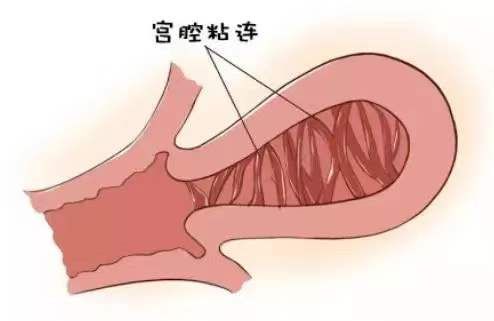 經過宮腔鏡檢查,結果並不容樂觀,李女士因為多次人工流產及術後未及時